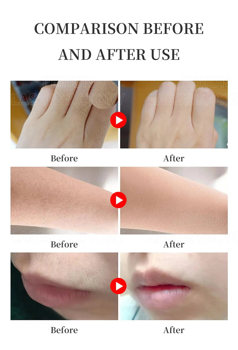 2025 Portable 808 4-Wave Diode Laser Hair Removal Device