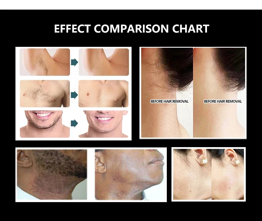 2025 Portable 808 4-Wave Diode Laser Hair Removal Device