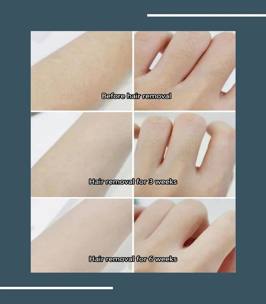 2025 Portable 808 4-Wave Diode Laser Hair Removal Device